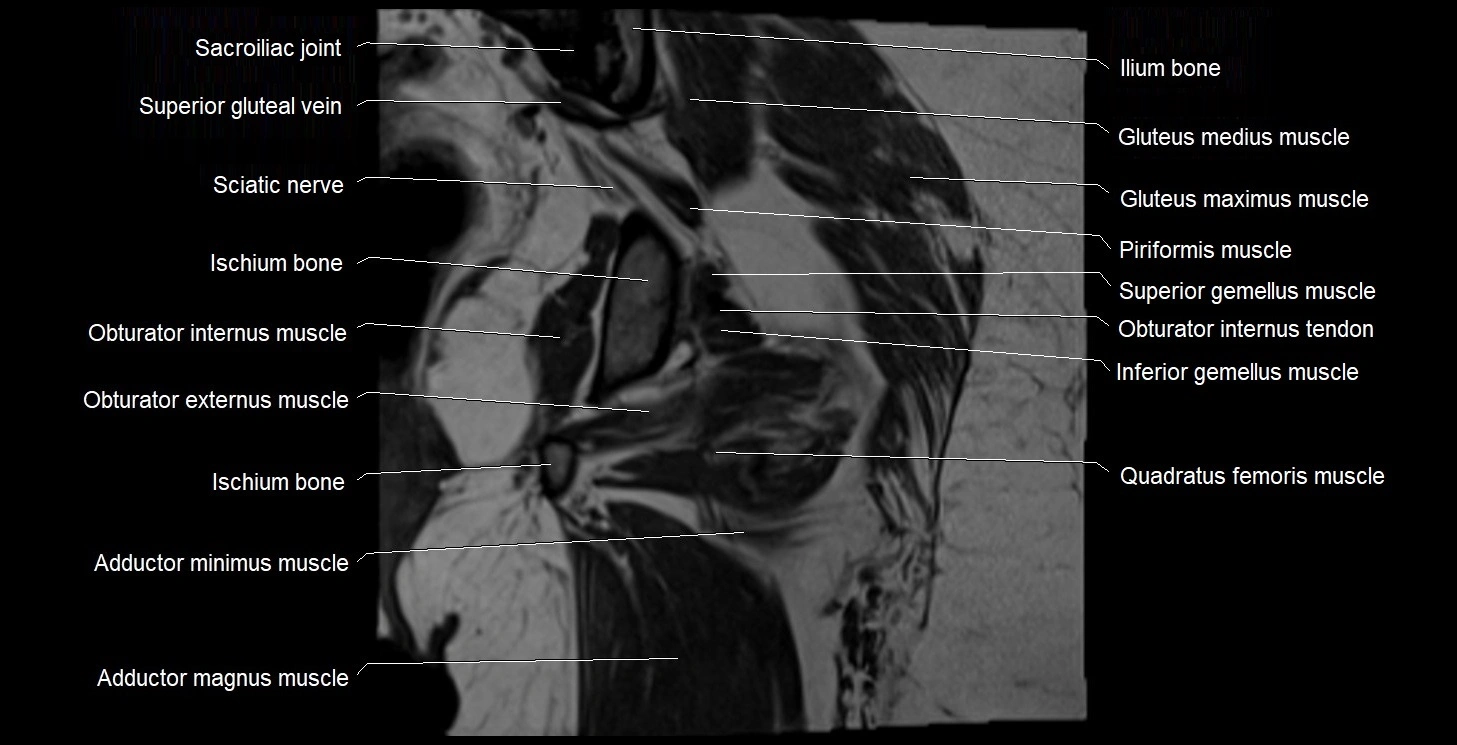 MRI Hip 3T coronal cross sectional anatomy image 45.webp